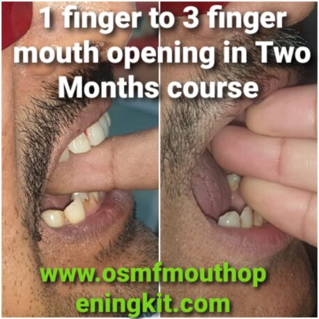 oral submucous fibrosis mouth opening treatment at home kit india result